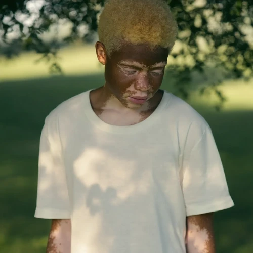 Vitiligo Increases Depression Risk for Black and Hispanic Patients